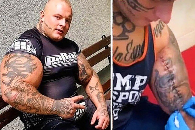 Muscles made by injection of alcohol and oil and then doctors had to apply 80 stitches